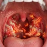 strep throat increasing in 2026 symptoms and testing guide